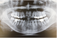 デジタルレントゲンCT